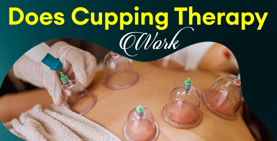 Does Cupping Therapy Work?